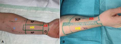 phalloplasty results 2018|Patient.